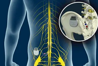 Spinal Cord Stimulator